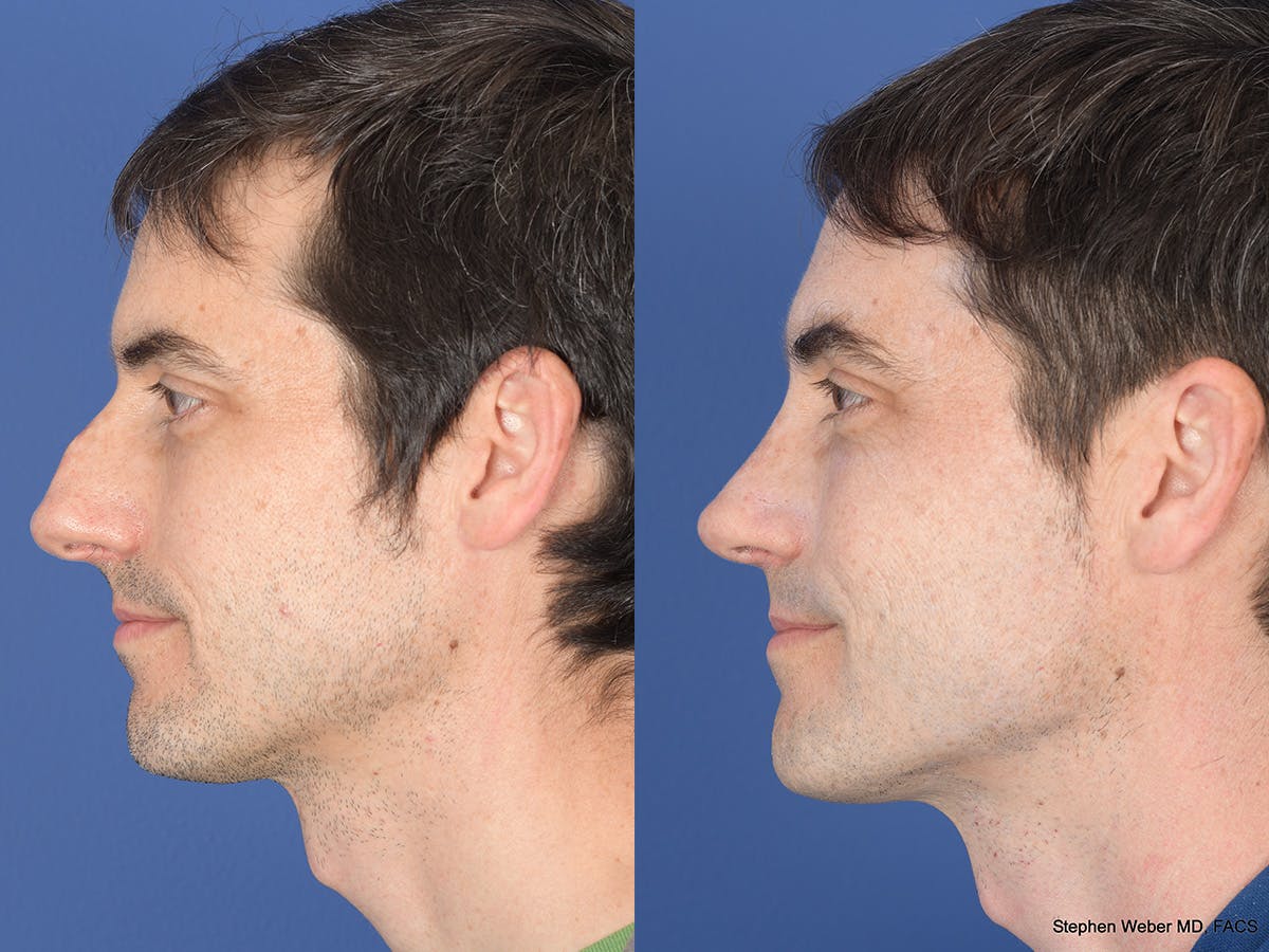 Rhinoplasty Before & After Gallery - Patient 282174 - Image 2