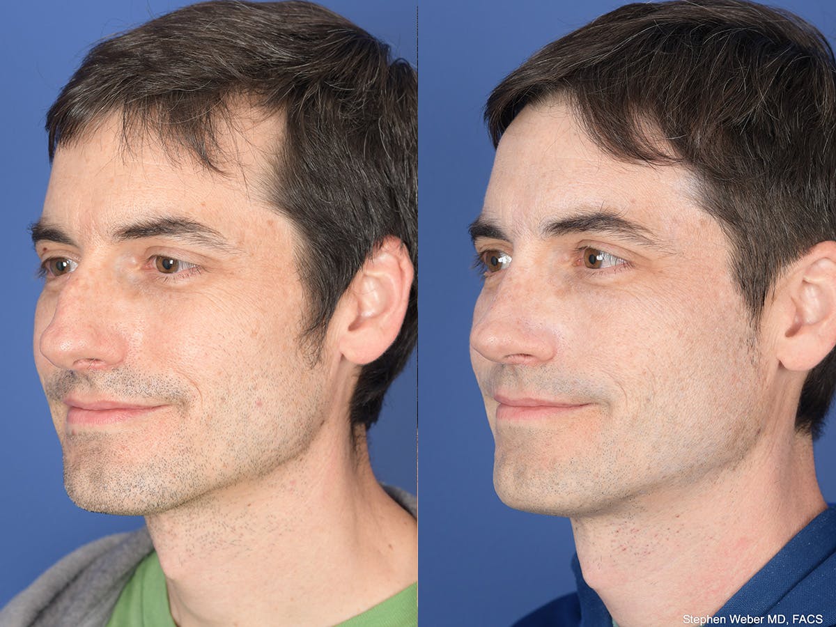 Rhinoplasty Before & After Gallery - Patient 282174 - Image 3