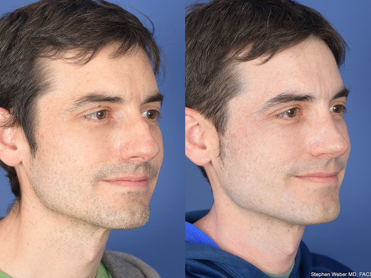 Rhinoplasty Before & After Gallery - Patient 282174 - Image 4