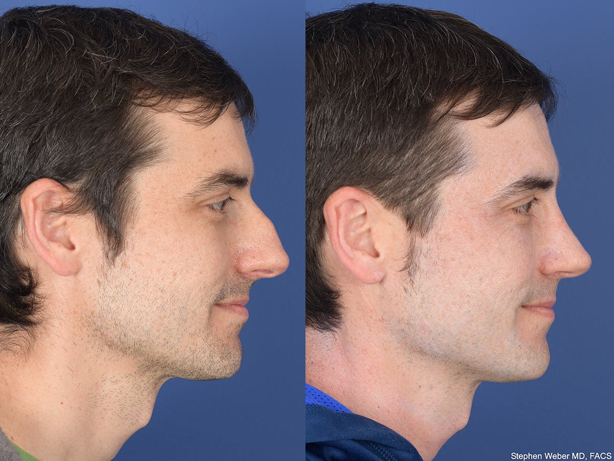 Rhinoplasty Before & After Gallery - Patient 282174 - Image 5