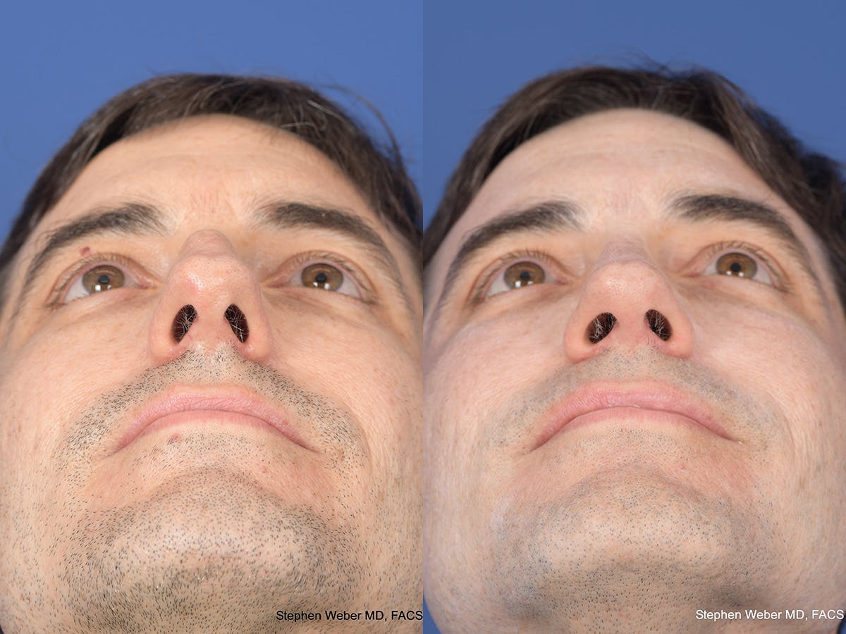 Rhinoplasty Before & After Gallery - Patient 282174 - Image 6