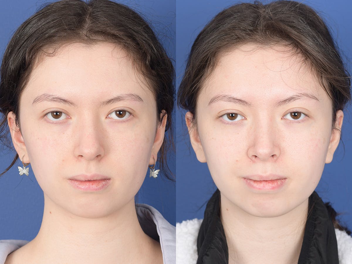 Rhinoplasty Before & After Gallery - Patient 353350 - Image 1