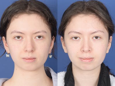 Rhinoplasty Before & After Gallery - Patient 353350 - Image 1