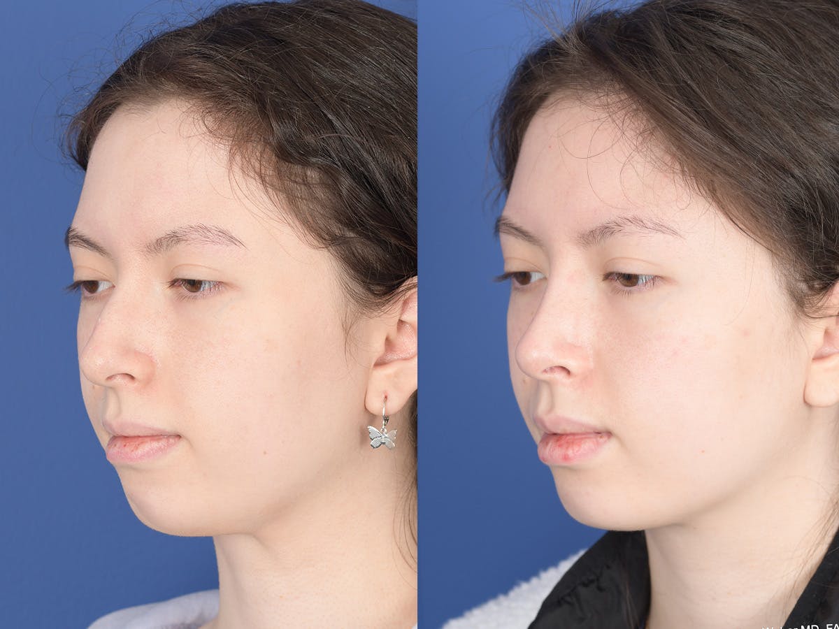 Rhinoplasty Before & After Gallery - Patient 353350 - Image 3