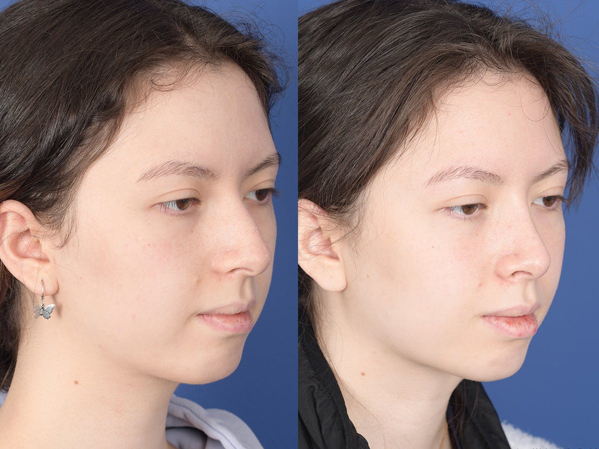 Rhinoplasty Before & After Gallery - Patient 353350 - Image 4