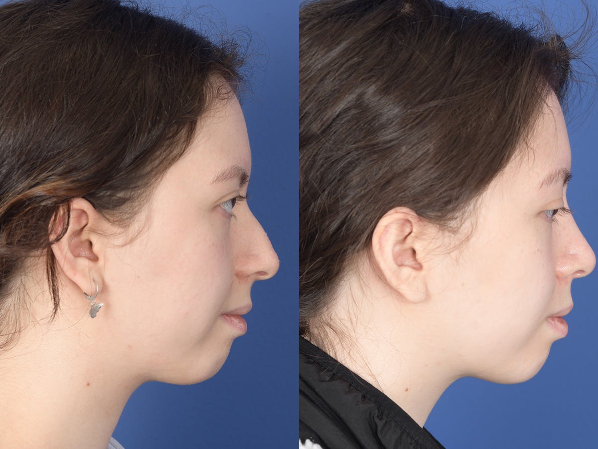 Rhinoplasty Before & After Gallery - Patient 353350 - Image 5