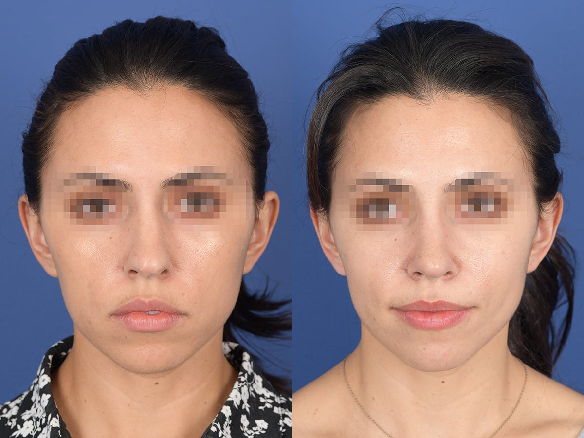 Rhinoplasty Before & After Gallery - Patient 542742 - Image 1
