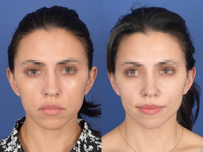 Rhinoplasty Before & After Gallery - Patient 542742 - Image 1