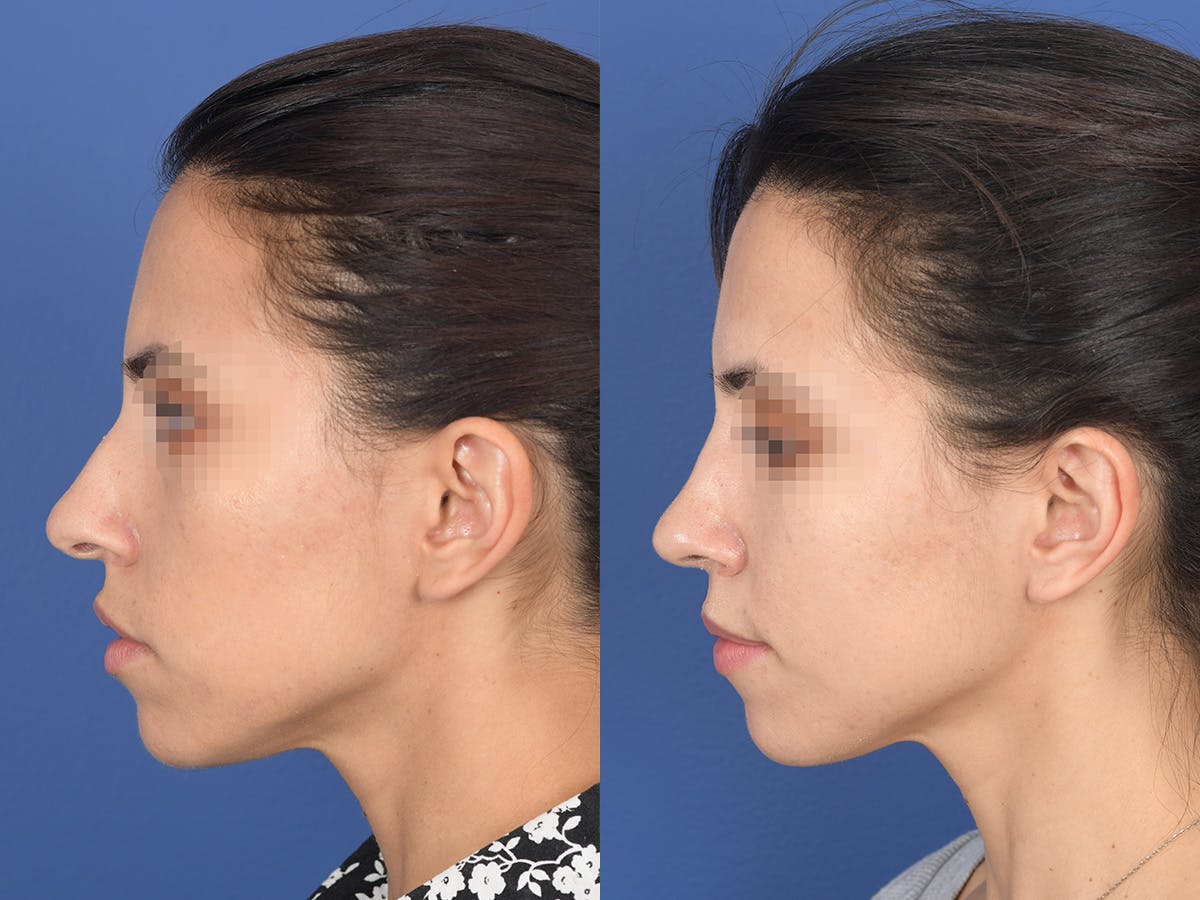 Rhinoplasty Before & After Gallery - Patient 542742 - Image 2