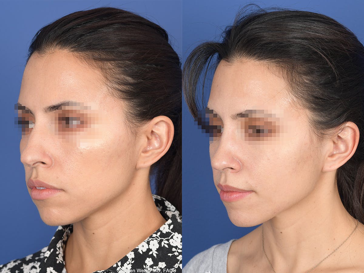 Rhinoplasty Before & After Gallery - Patient 542742 - Image 3