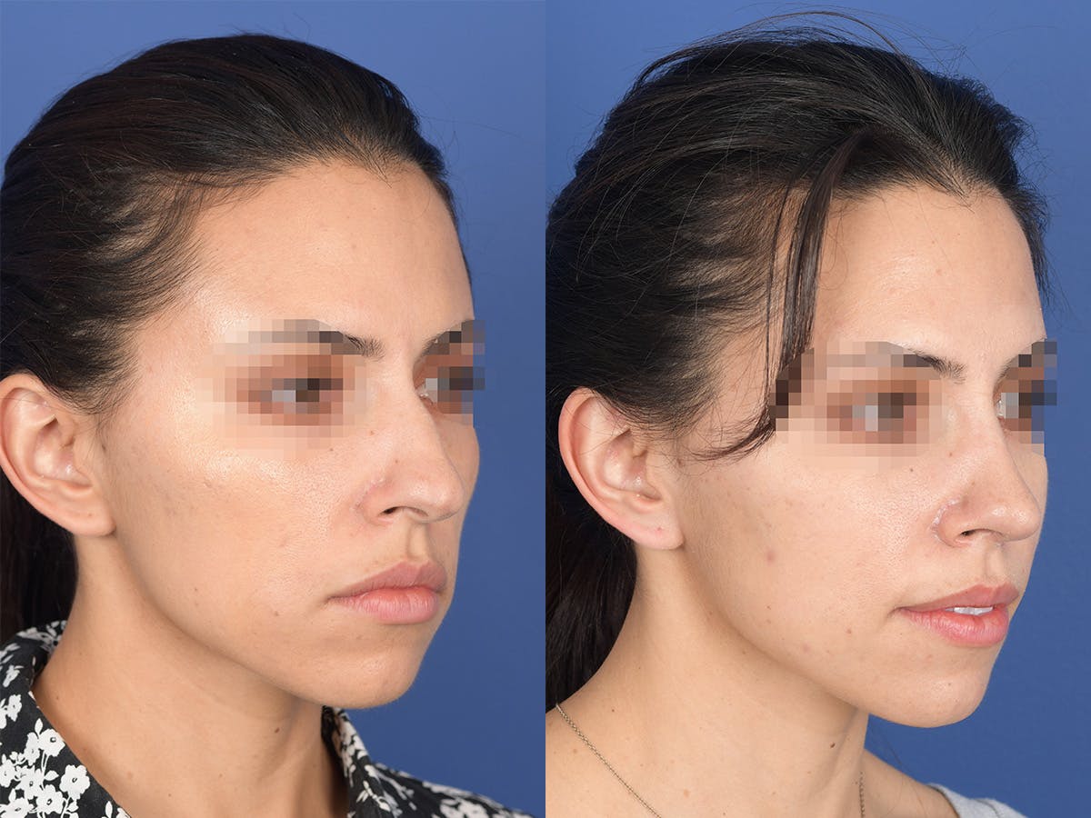 Rhinoplasty Before & After Gallery - Patient 542742 - Image 4