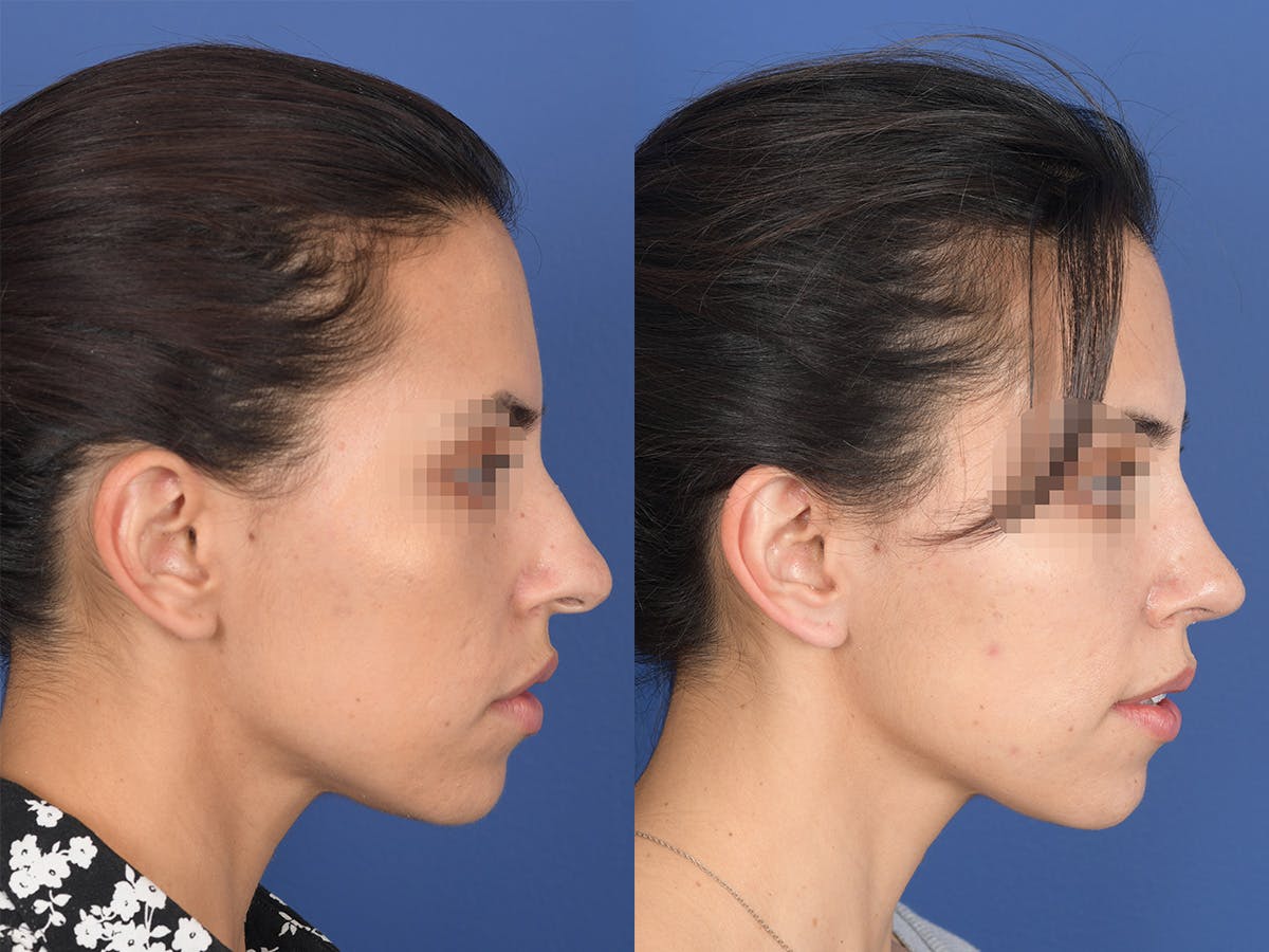 Rhinoplasty Before & After Gallery - Patient 542742 - Image 5