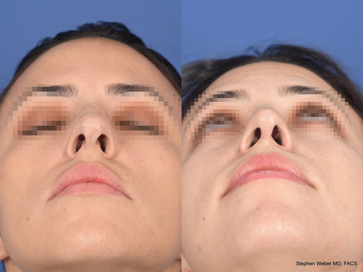 Rhinoplasty Before & After Gallery - Patient 542742 - Image 6