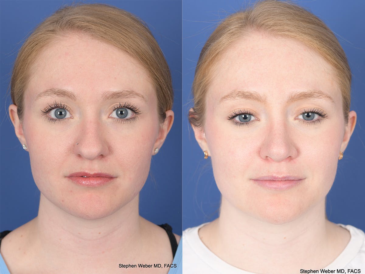 Rhinoplasty Before & After Gallery - Patient 180551 - Image 1