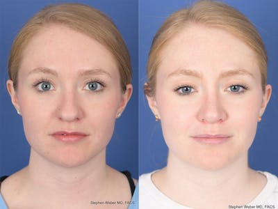 Rhinoplasty Before & After Gallery - Patient 180551 - Image 1