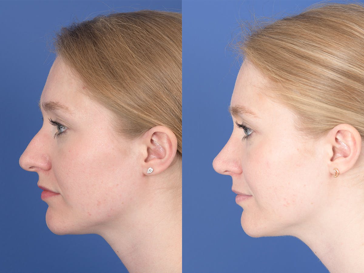 Rhinoplasty Before & After Gallery - Patient 180551 - Image 2