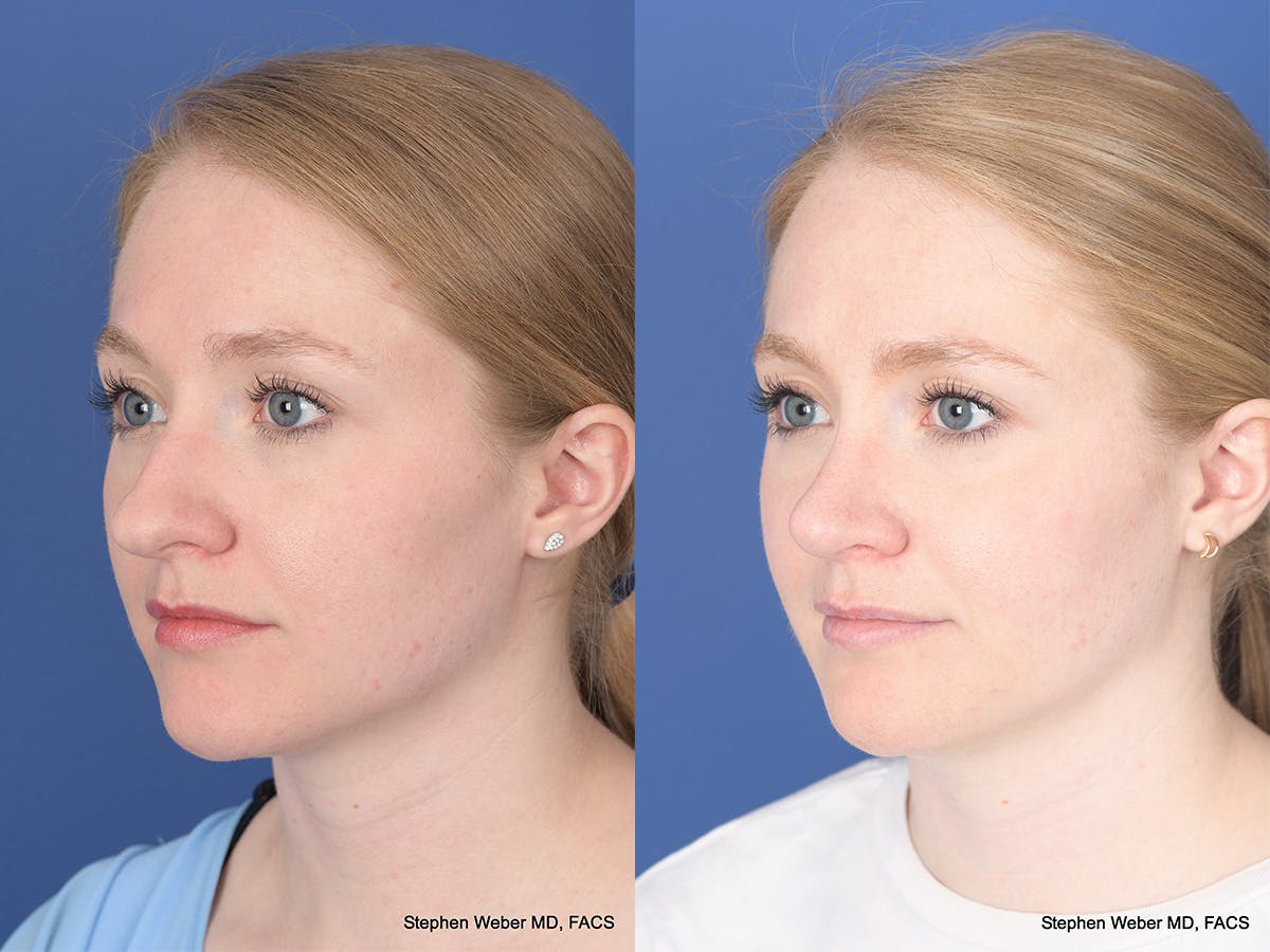 Rhinoplasty Before & After Gallery - Patient 180551 - Image 3