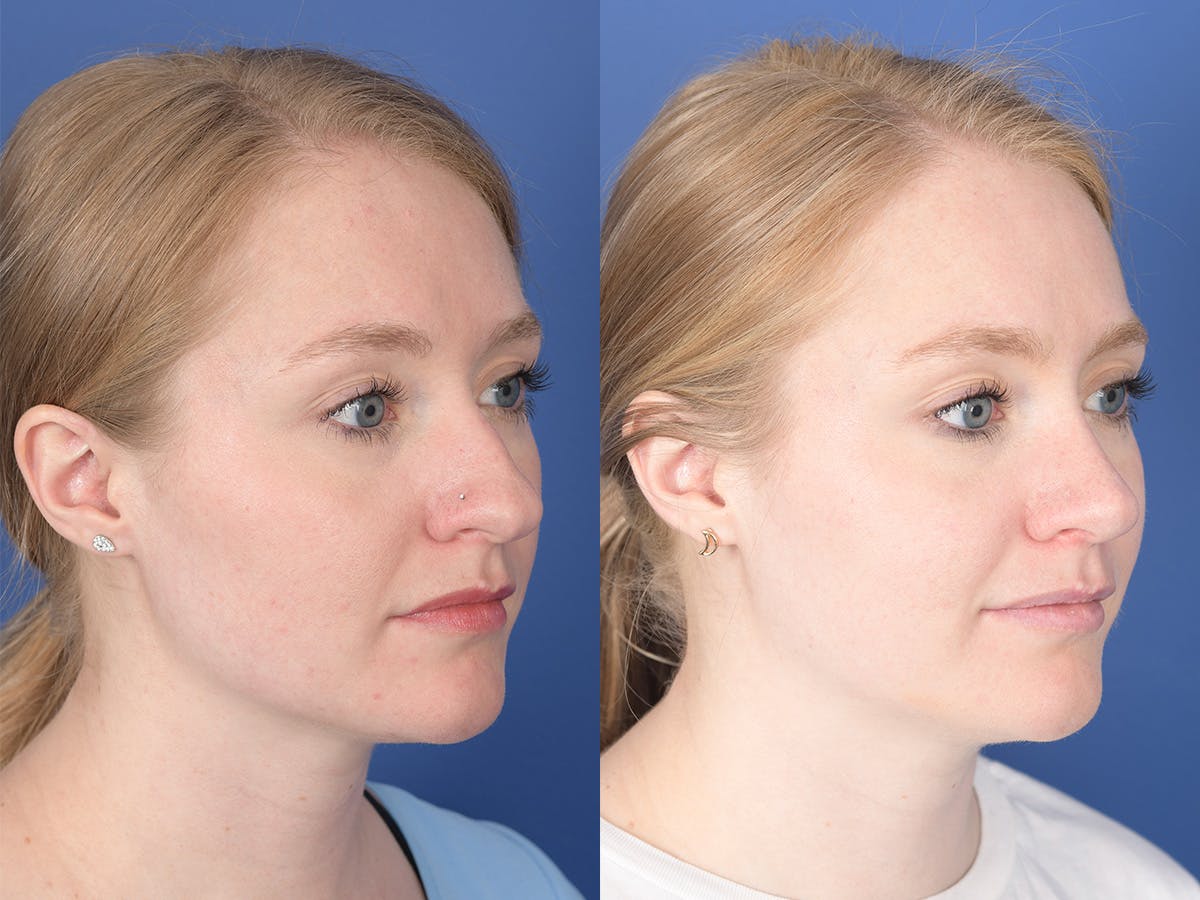 Rhinoplasty Before & After Gallery - Patient 180551 - Image 4