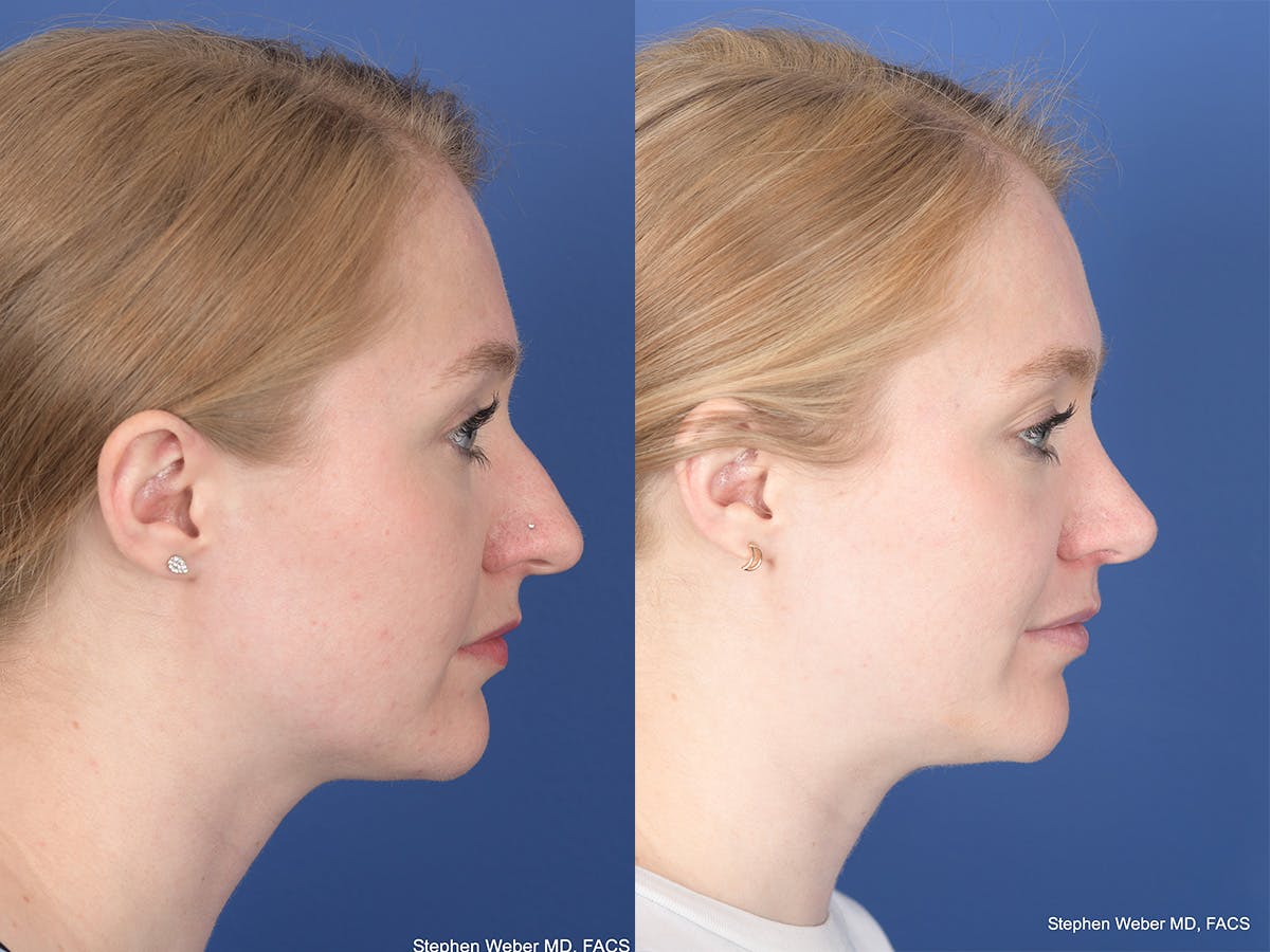 Rhinoplasty Before & After Gallery - Patient 180551 - Image 5