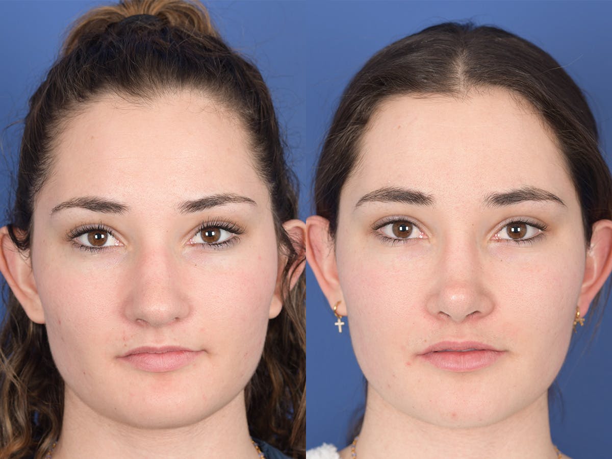 Rhinoplasty Before & After Gallery - Patient 331445 - Image 1