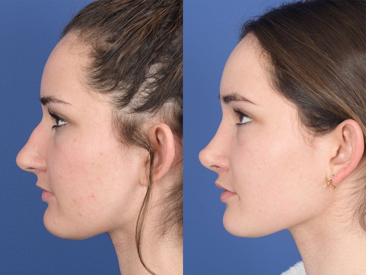 Rhinoplasty Before & After Gallery - Patient 331445 - Image 2