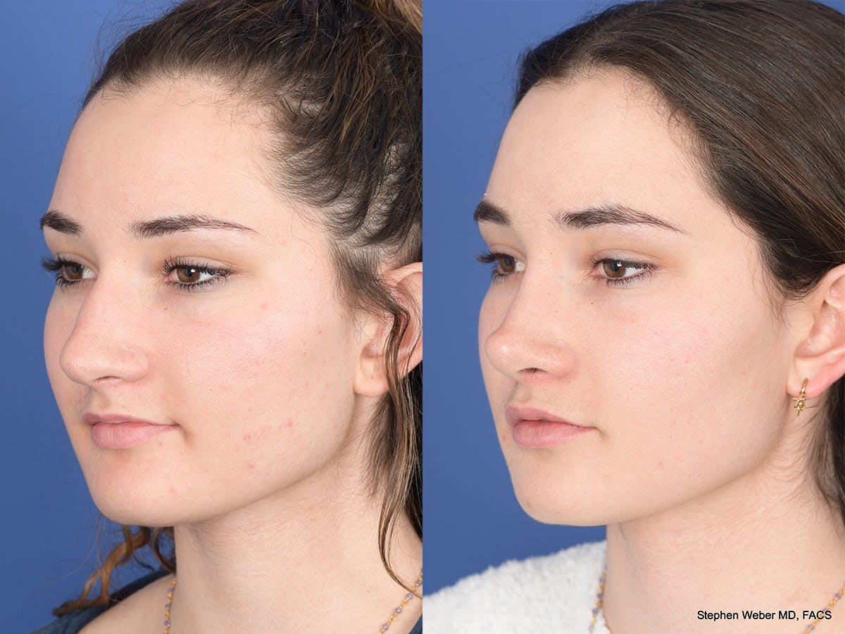 Rhinoplasty Before & After Gallery - Patient 331445 - Image 3
