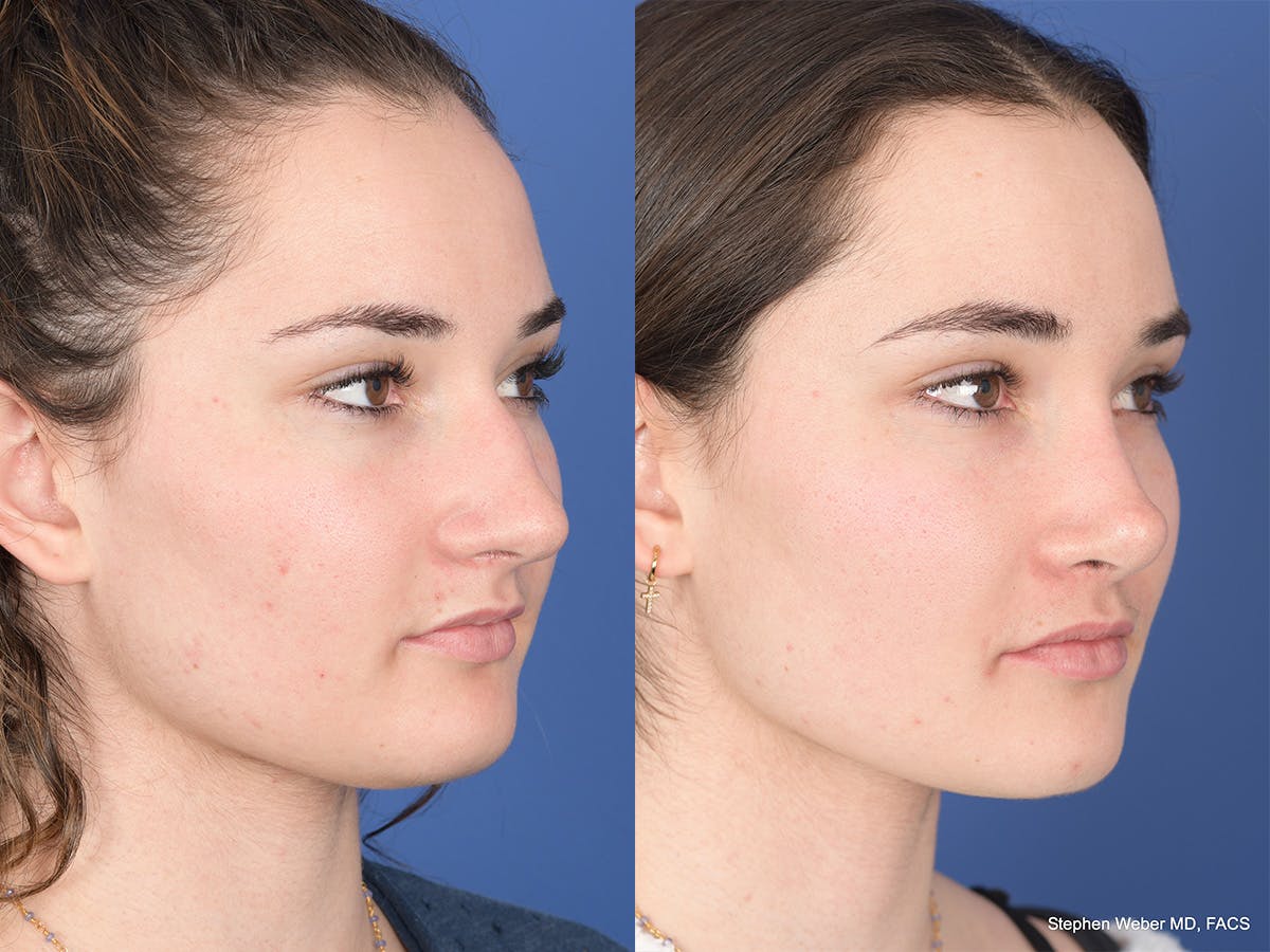 Rhinoplasty Before & After Gallery - Patient 331445 - Image 4