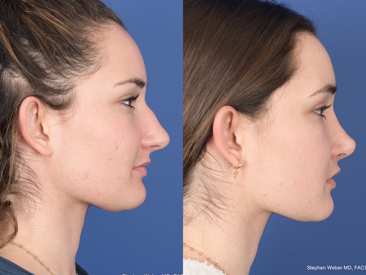 Rhinoplasty Before & After Gallery - Patient 331445 - Image 5