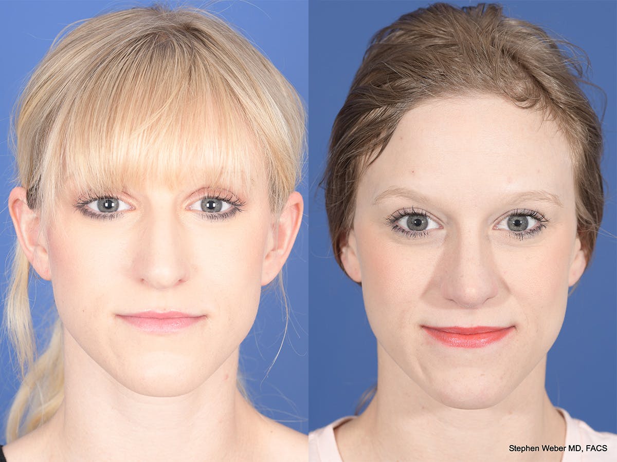 Rhinoplasty Before & After Gallery - Patient 332445 - Image 1