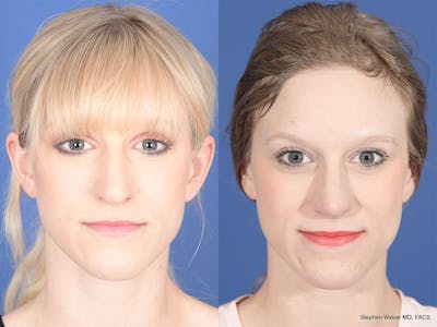 Rhinoplasty Before & After Gallery - Patient 332445 - Image 1