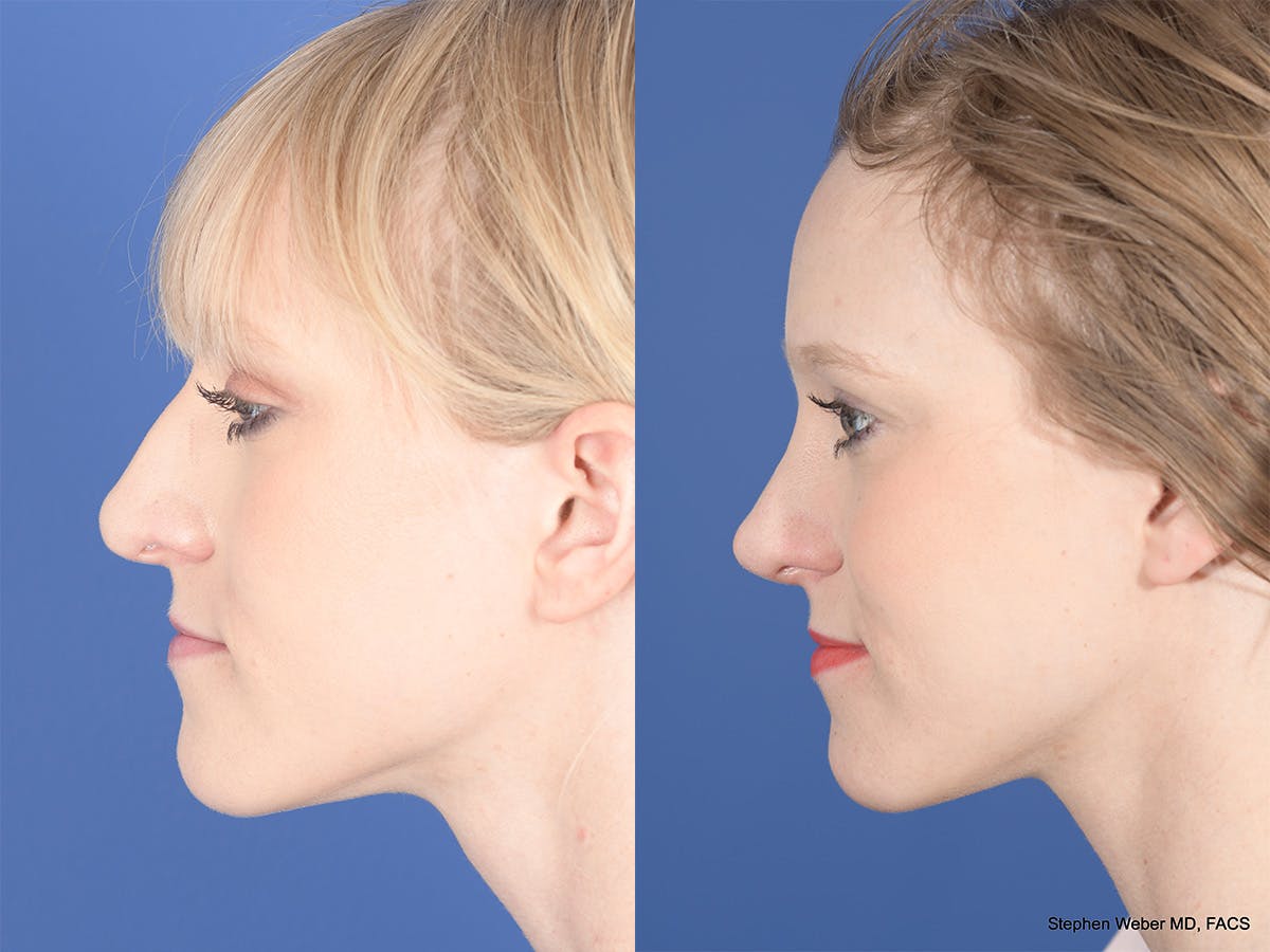 Rhinoplasty Before & After Gallery - Patient 332445 - Image 2
