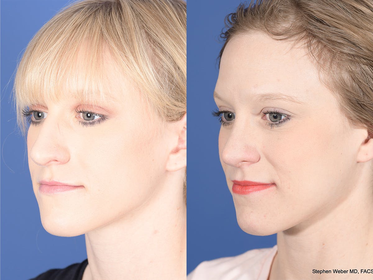 Rhinoplasty Before & After Gallery - Patient 332445 - Image 3