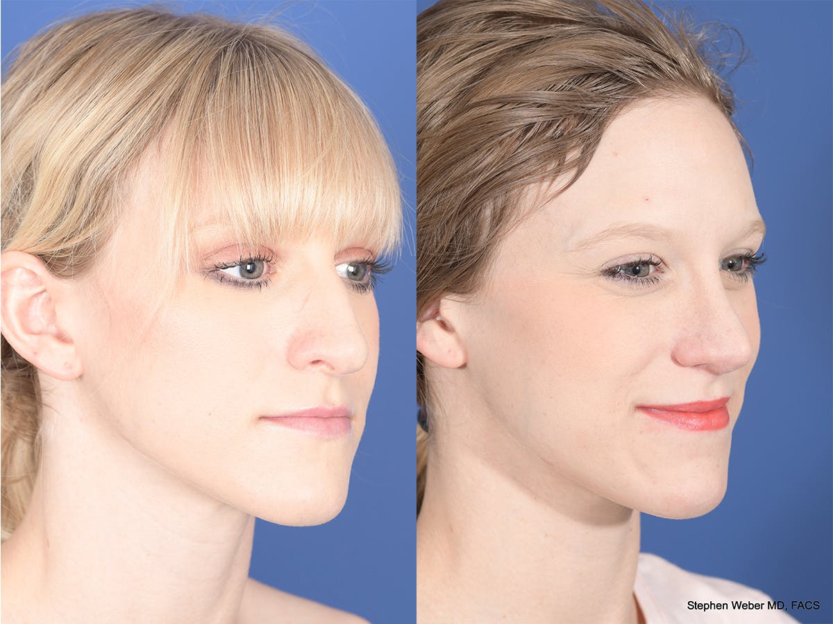 Rhinoplasty Before & After Gallery - Patient 332445 - Image 4