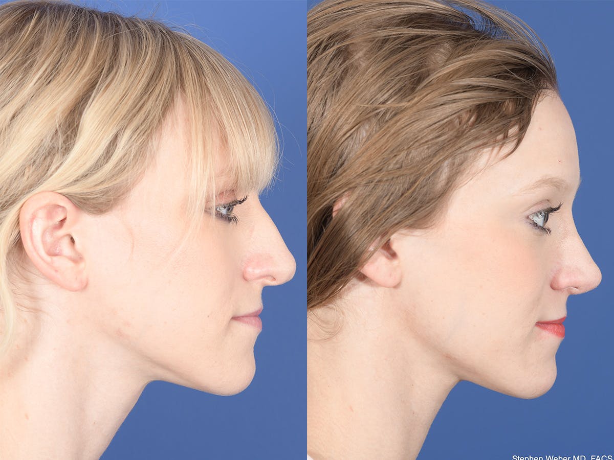 Rhinoplasty Before & After Gallery - Patient 332445 - Image 5