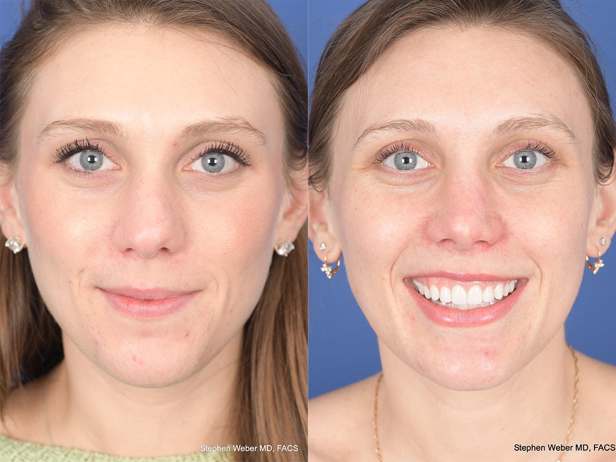 Rhinoplasty Before & After Gallery - Patient 258513 - Image 1