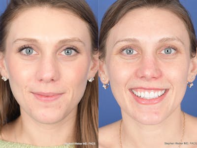 Rhinoplasty Before & After Gallery - Patient 258513 - Image 1