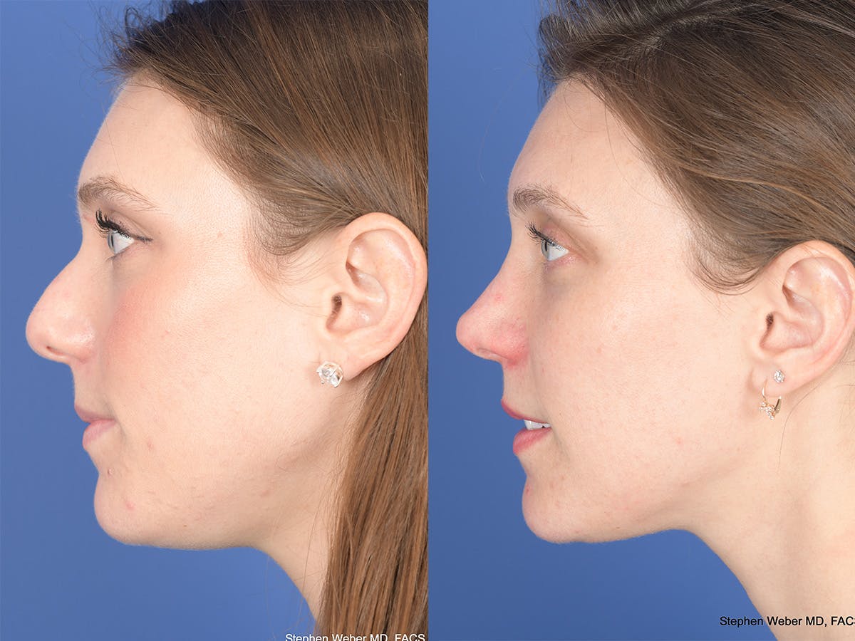 Rhinoplasty Before & After Gallery - Patient 258513 - Image 2