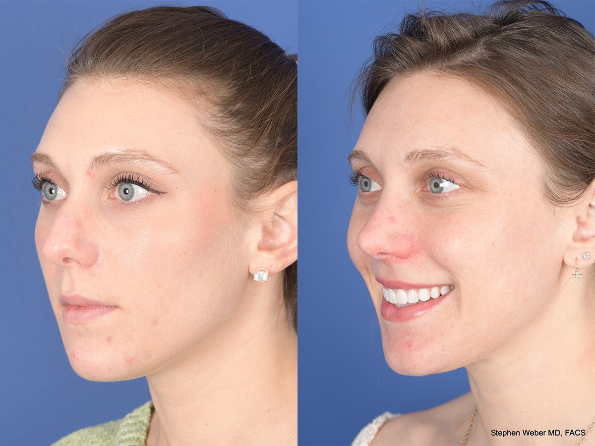 Rhinoplasty Before & After Gallery - Patient 258513 - Image 3