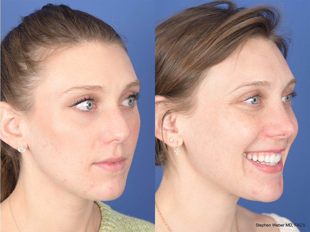 Rhinoplasty Before & After Gallery - Patient 258513 - Image 4