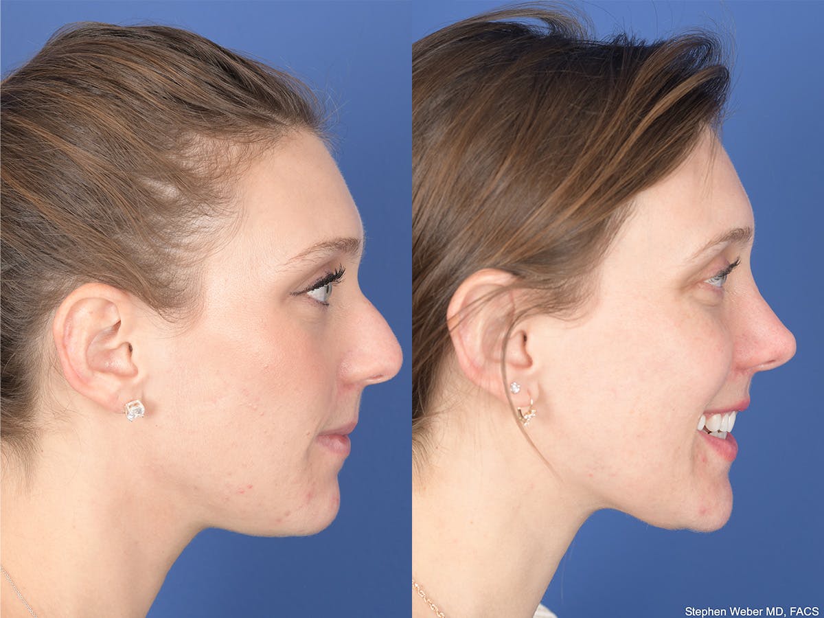 Rhinoplasty Before & After Gallery - Patient 258513 - Image 5