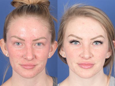 Rhinoplasty Before & After Gallery - Patient 183883 - Image 1