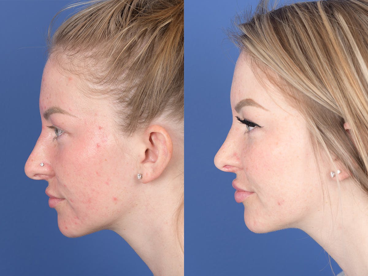 Rhinoplasty Before & After Gallery - Patient 183883 - Image 2