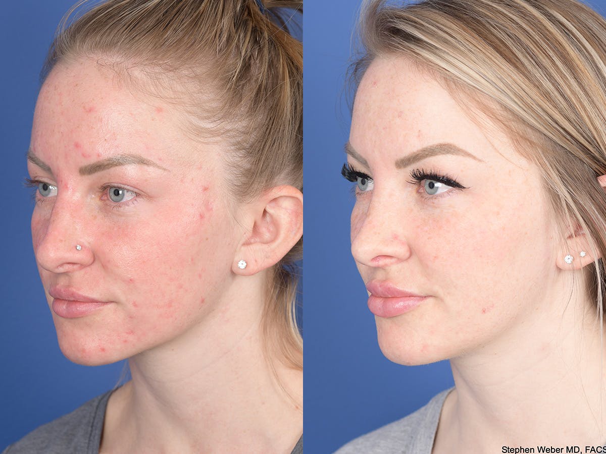 Rhinoplasty Before & After Gallery - Patient 183883 - Image 3