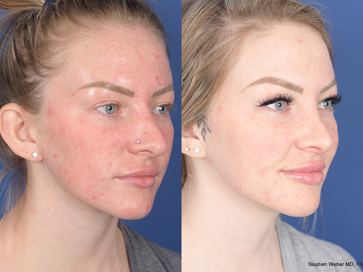 Rhinoplasty Before & After Gallery - Patient 183883 - Image 4