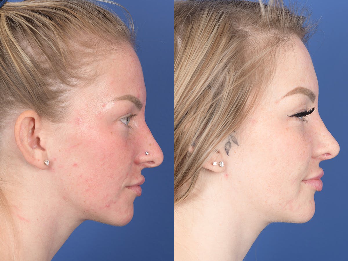 Rhinoplasty Before & After Gallery - Patient 183883 - Image 5