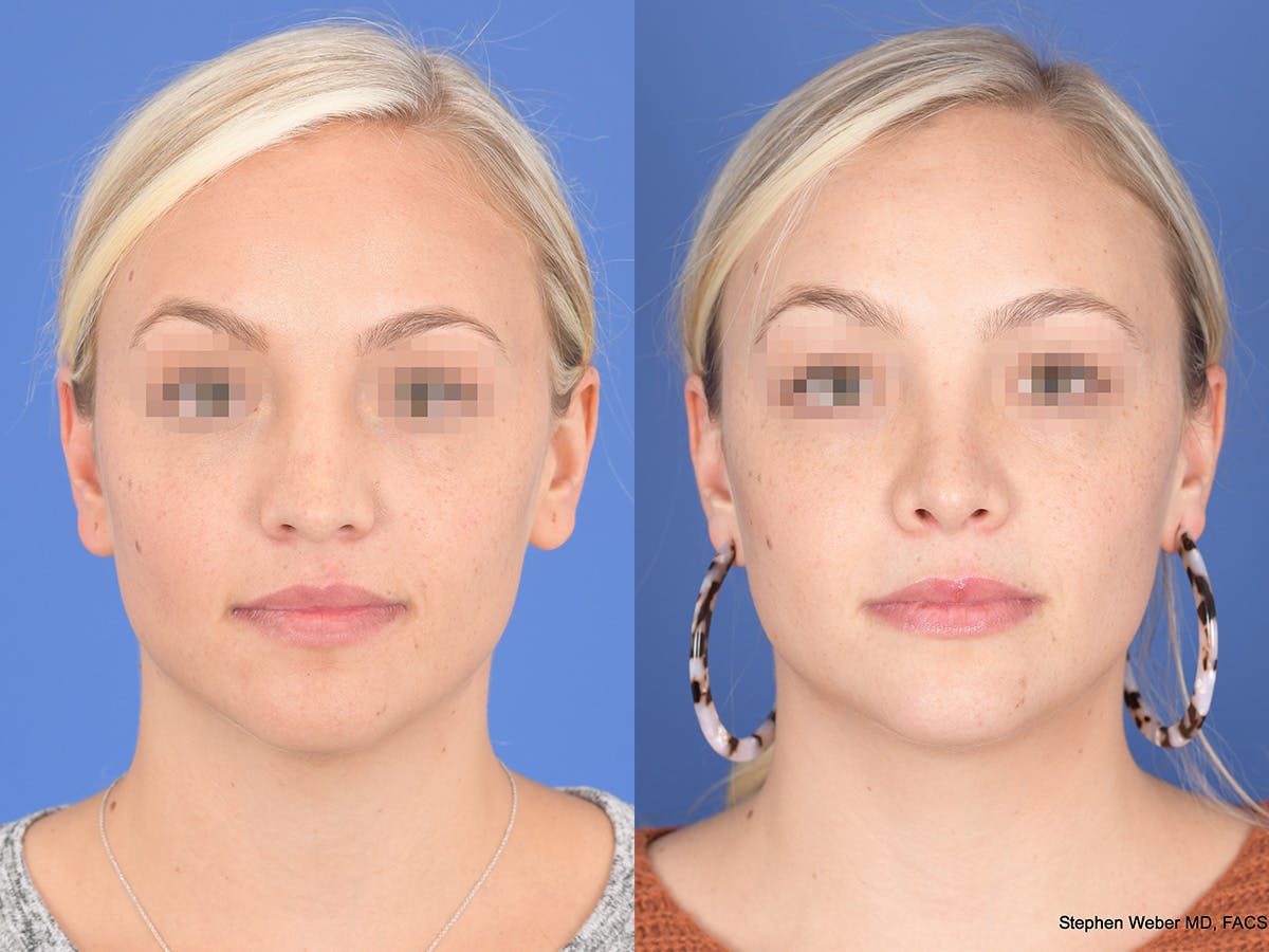 Rhinoplasty Before & After Gallery - Patient 429210 - Image 1