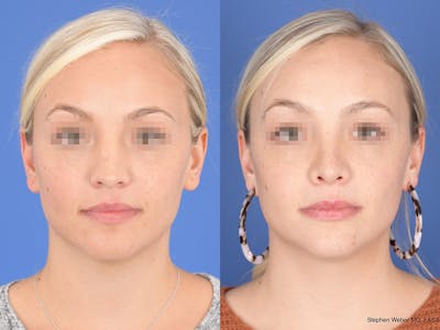 Rhinoplasty Before & After Gallery - Patient 429210 - Image 1