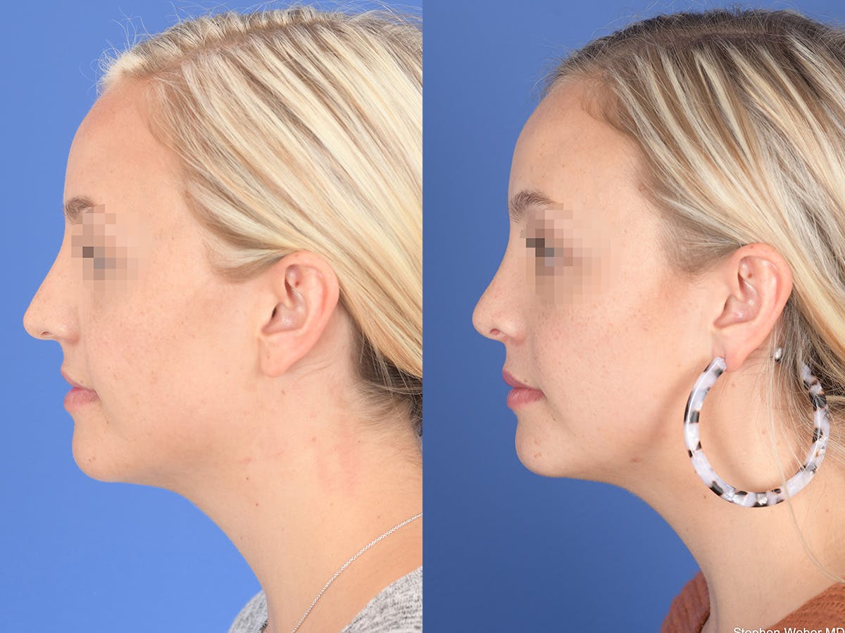 Rhinoplasty Before & After Gallery - Patient 429210 - Image 2