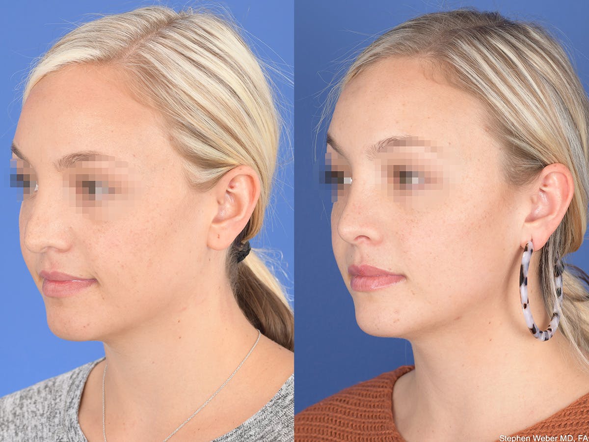 Rhinoplasty Before & After Gallery - Patient 429210 - Image 3