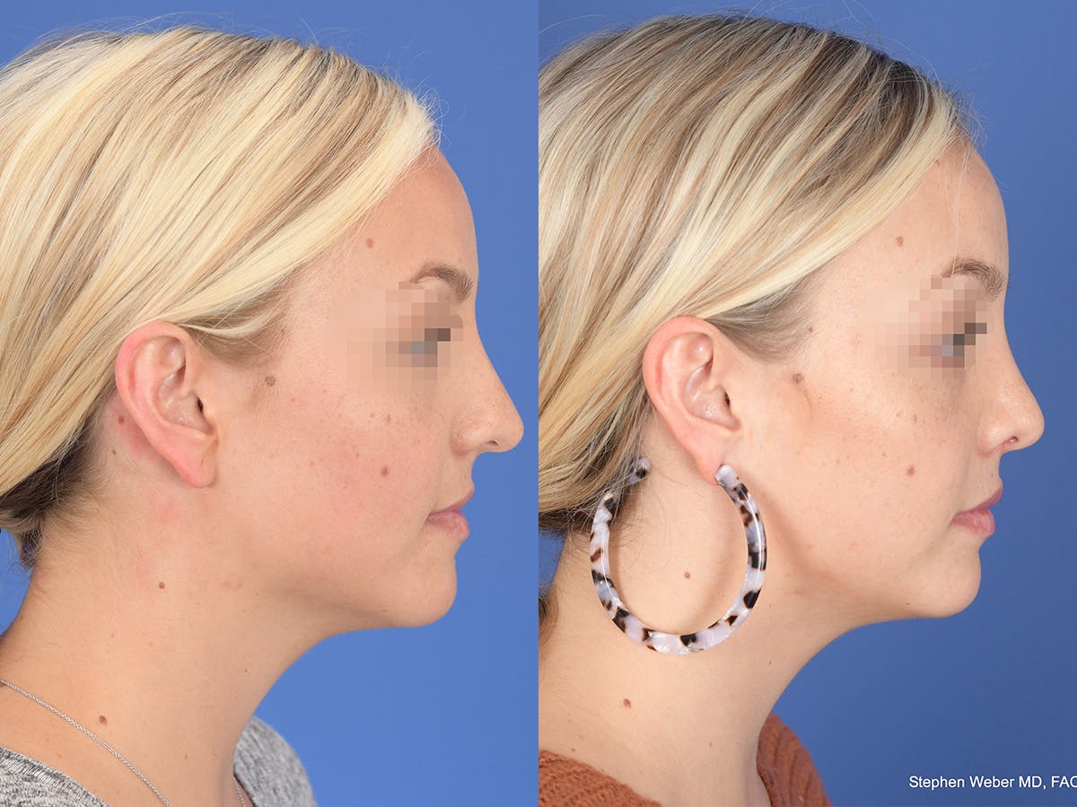 Rhinoplasty Before & After Gallery - Patient 429210 - Image 4